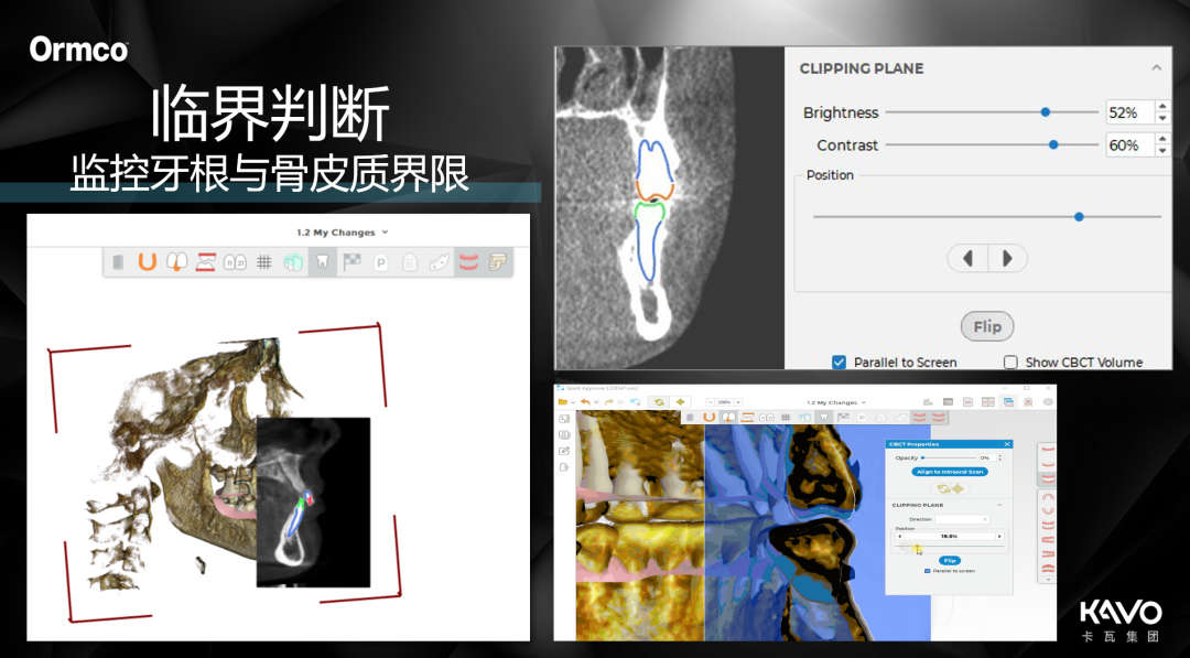 精靓SPARK隐形正畸新升级，3D根骨系统守护美丽微笑